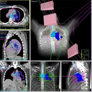 Image-Guided Radiation Therapy Used To Treat "Oligometastasis"